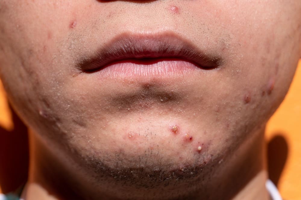 What-is-Acne-Understanding-the-Skin-Problem-Behind-It