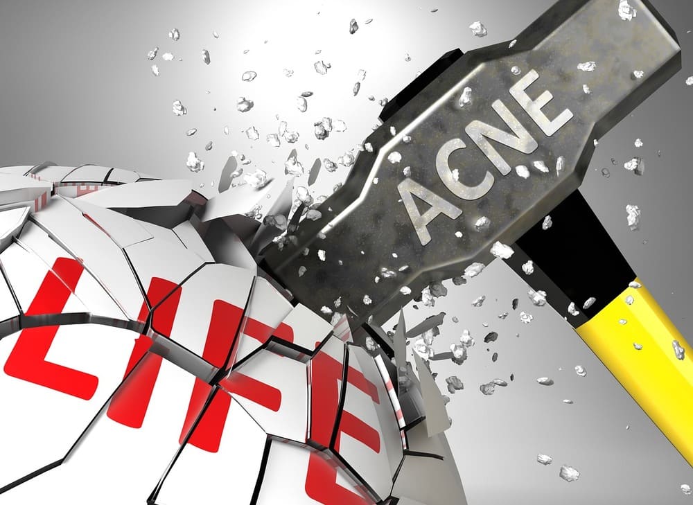 fighting-acne