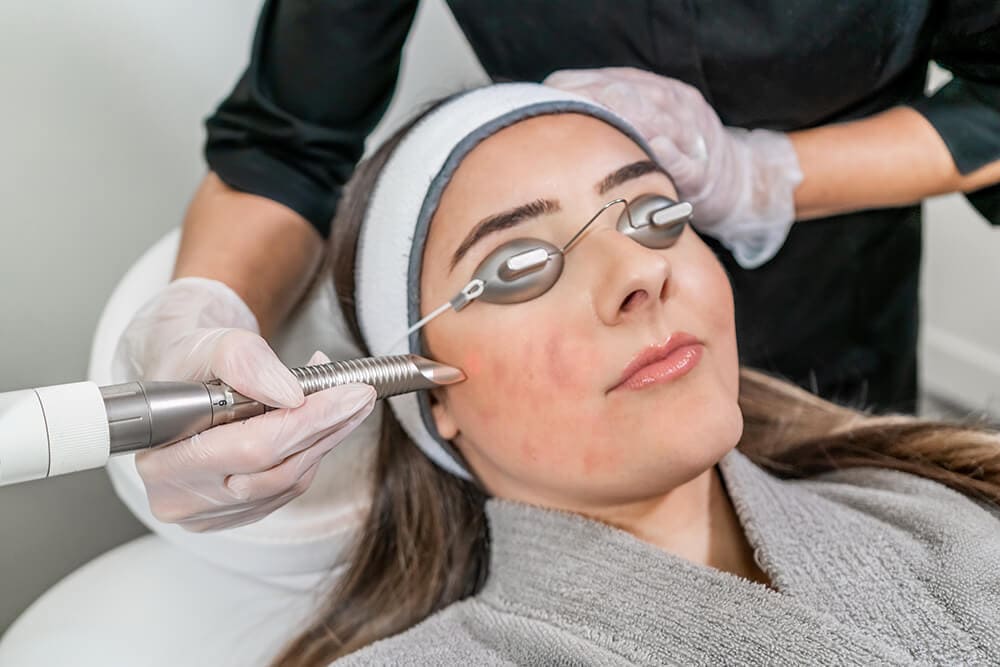 Acne-Treated-with-a-Laser