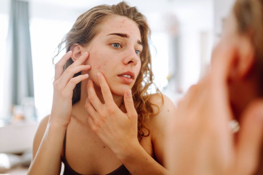Woman-Popping-Pimples