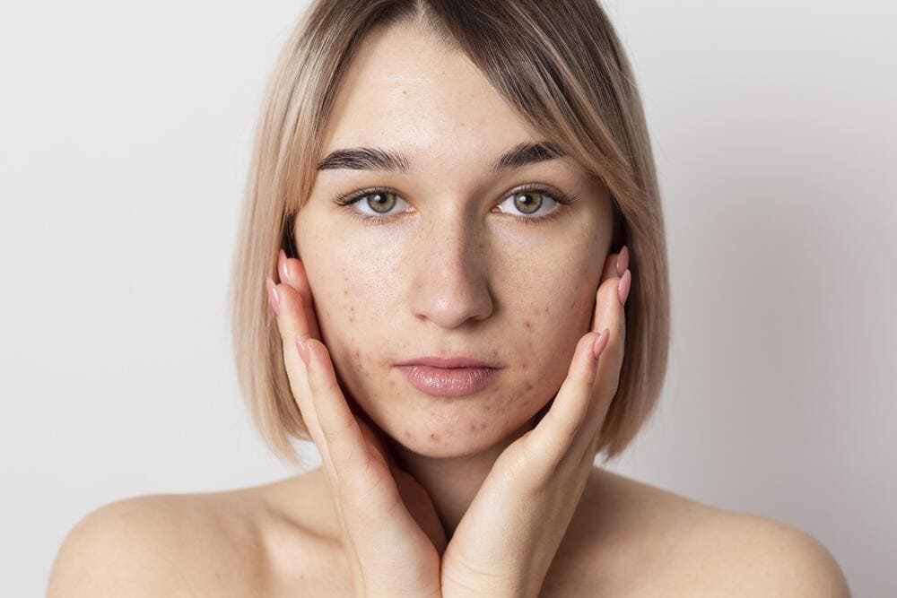 close-up-beautiful-woman-with-a-truth-acne-face