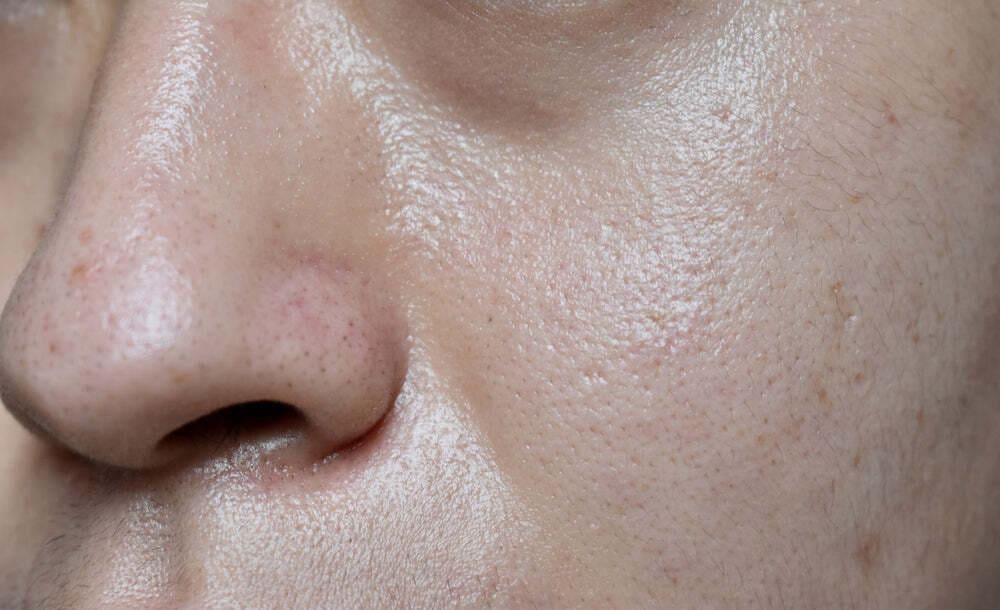 person-with-oily-skin-who-needs-help