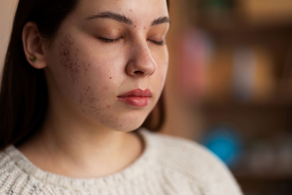 person-dealing-with-acne